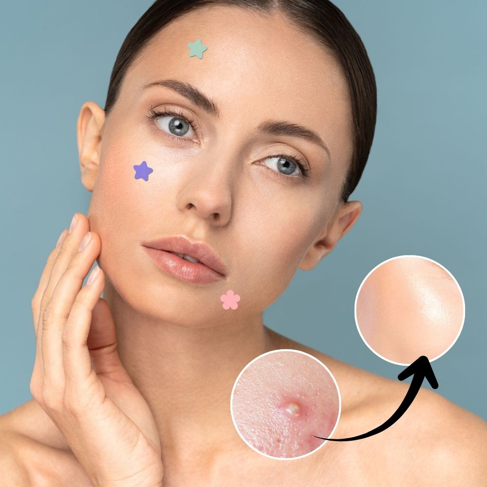 Hydrocolloid Pimple Acne Patch Sticker | Practical, Durable & Designed to Make Everyday Life Easier