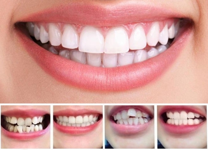 Invisible Dental Realignment Tray | Cleverly Designed for Everyday Use — You'll Wonder How You Managed Without It