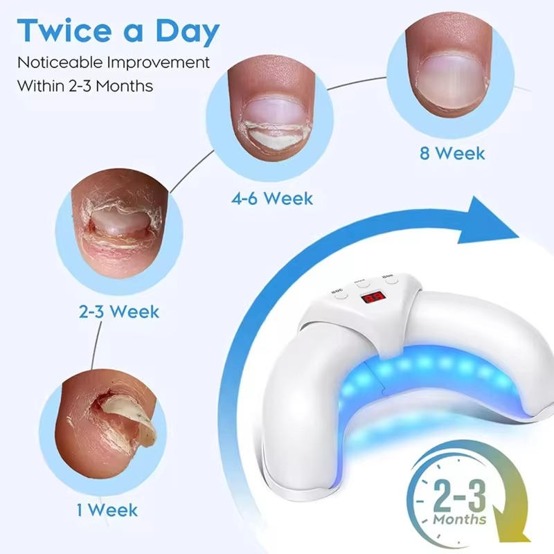 Nail Fungus Laser | Support Your Body, Reclaim Your Comfort & Move More Freely Every Day