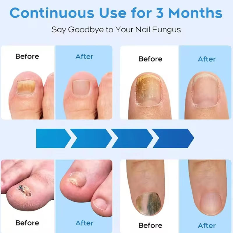 Nail Fungus Laser | Support Your Body, Reclaim Your Comfort & Move More Freely Every Day