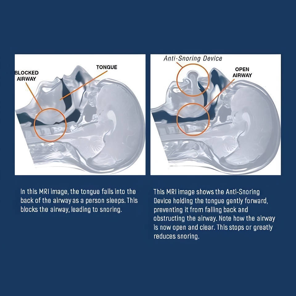 Sleep Apnea Tongue Retainer, Non-Invasive Snoring Relief Aid | Support Your Body, Reclaim Your Comfort & Move More Freely Every Day